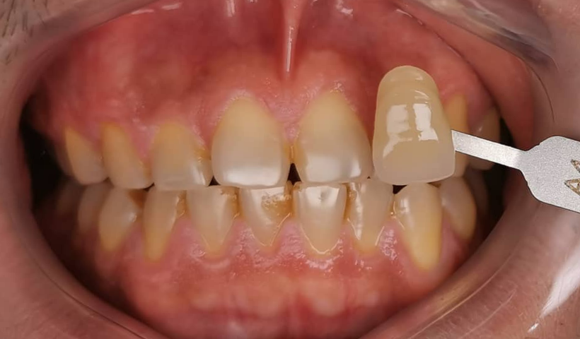 teeth whitening puchong