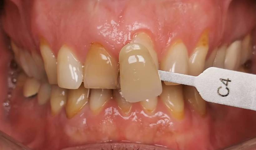 teeth whitening promotion