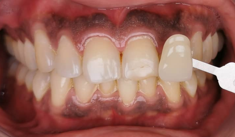 teeth whitening promo