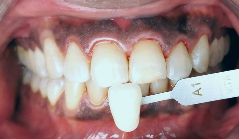 teeth whitening promo kl