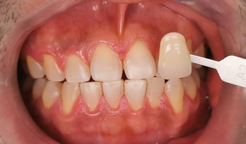 teeth whitening selangor